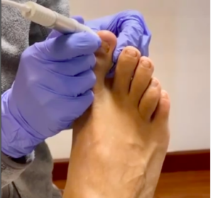 hongos en los pies uñas